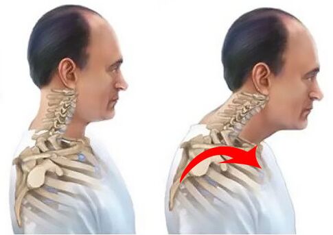 Colonna vertebrale sana e malata
