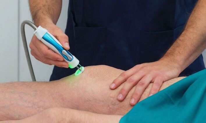 Termografia dell'articolazione del ginocchio in artrosi