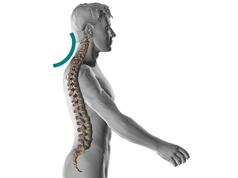 Osteocondrosi cervicale della colonna vertebrale, che causa molti sintomi spiacevoli