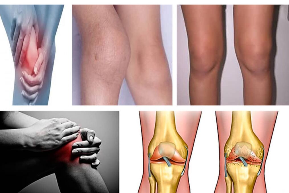 Sintomi dell'osteoartrosi del ginocchio